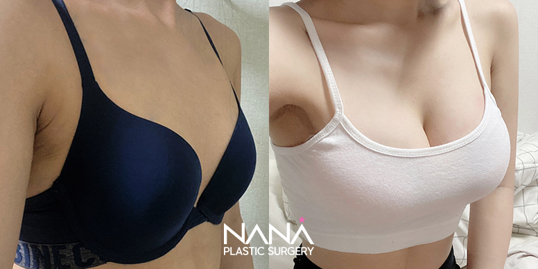 Breast Before & After — Before & After