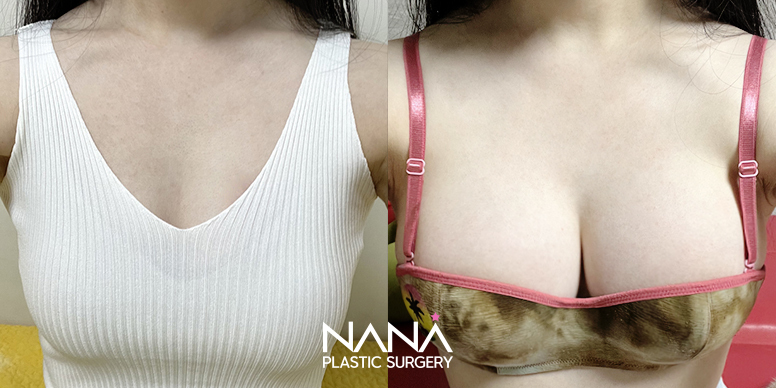 Breast Before & After — Before & After