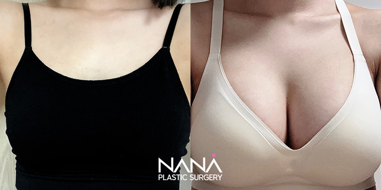 Breast Before & After — Before & After