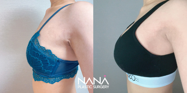 Breast Before & After — Before & After
