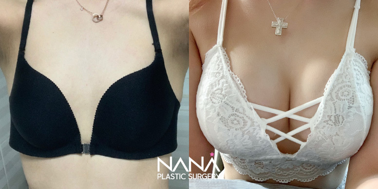 Breast Before & After — Before & After