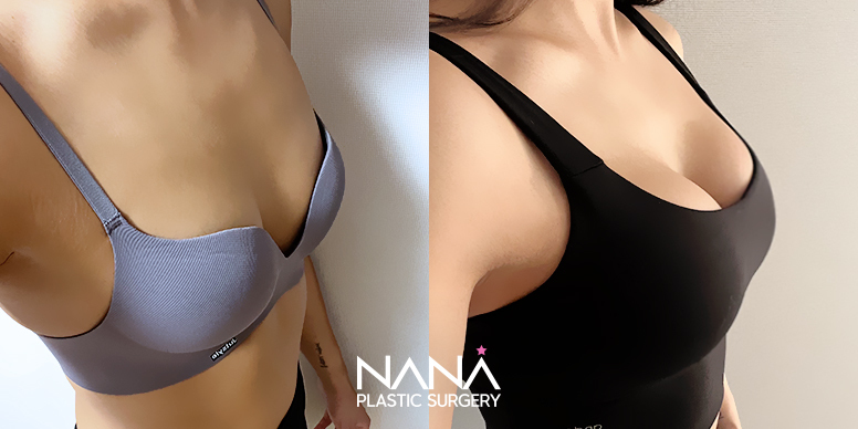 Breast Before & After — Before & After