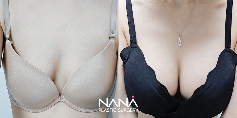 Breast Before & After — Before & After