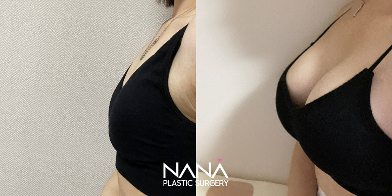 Breast Before & After — Before & After
