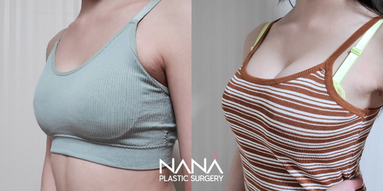 Breast Before & After — Before & After