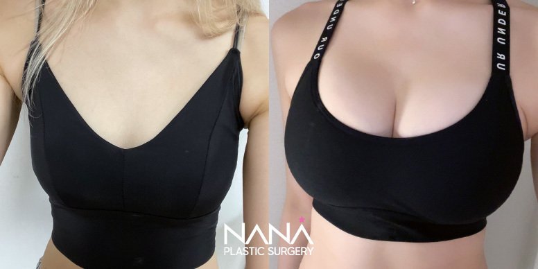 Breast Before & After — Before & After