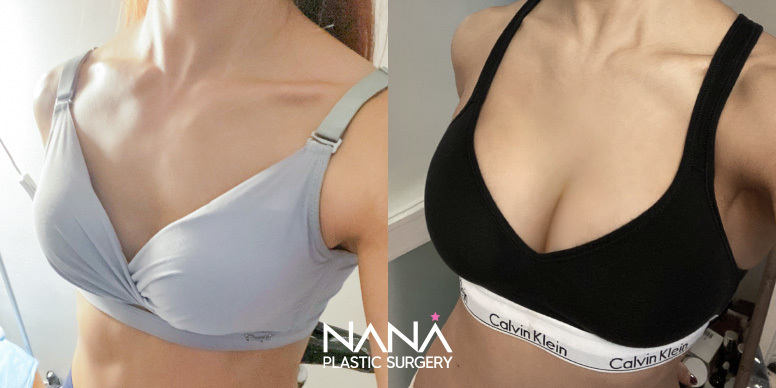Breast Before & After — Before & After