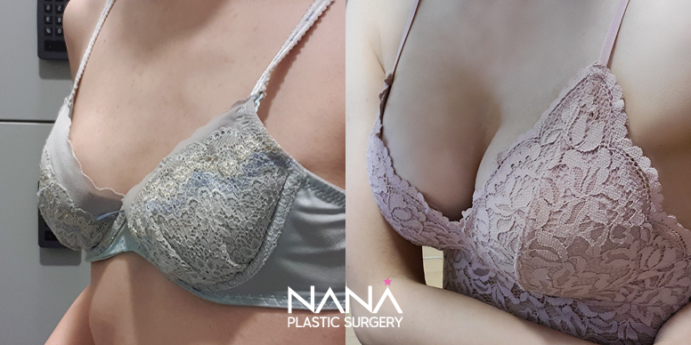 Breast Before & After — Before & After