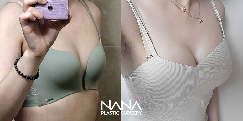 Breast Before & After — Before & After