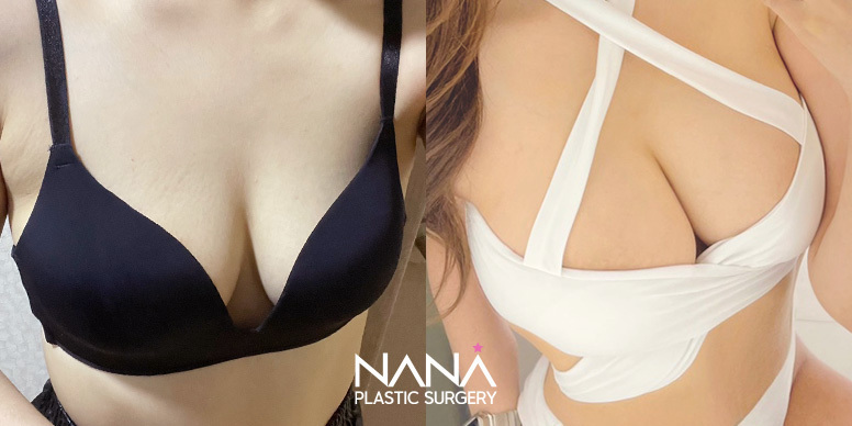Breast Before & After — Before & After