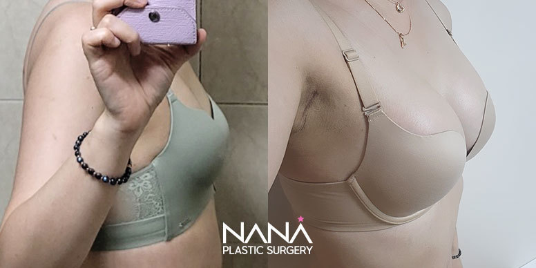 Breast Before & After — Before & After
