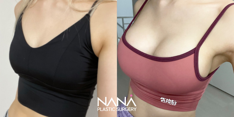 Breast Before & After — Before & After