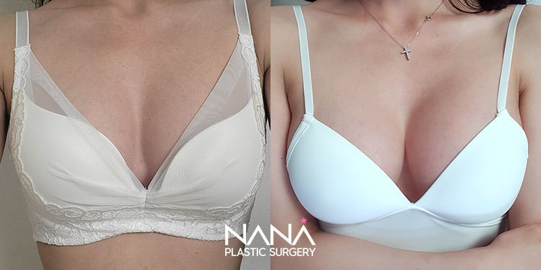 Breast Before & After — Before & After