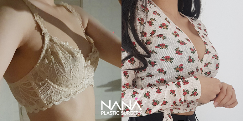 Breast Before & After — Before & After