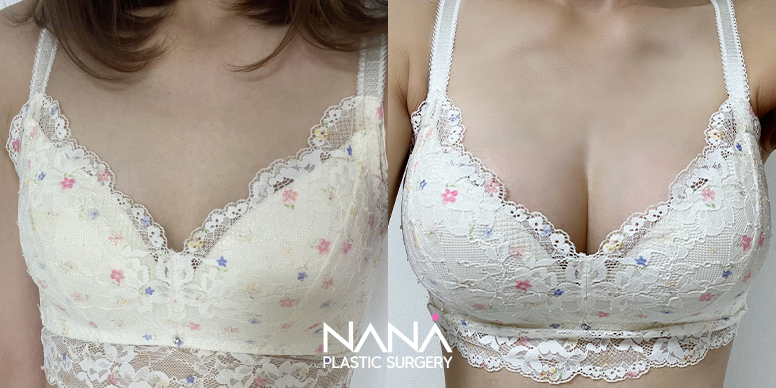 Breast Before & After — Before & After