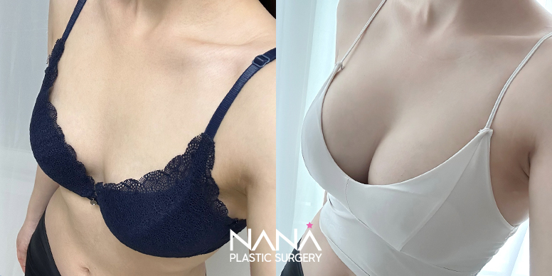 Breast Before & After — Before & After