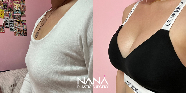 Breast Before & After — Before & After