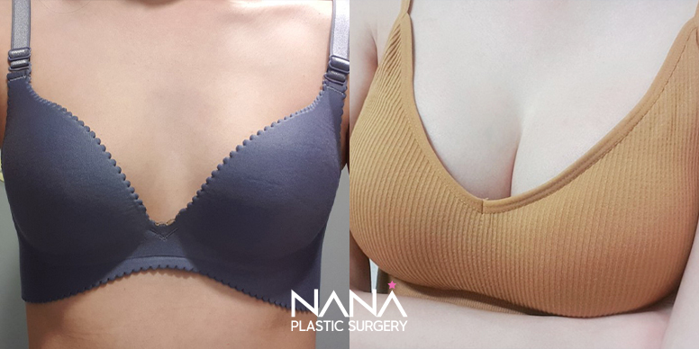 Breast Before & After — Before & After