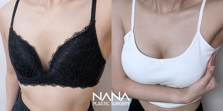 Breast Before & After — Before & After