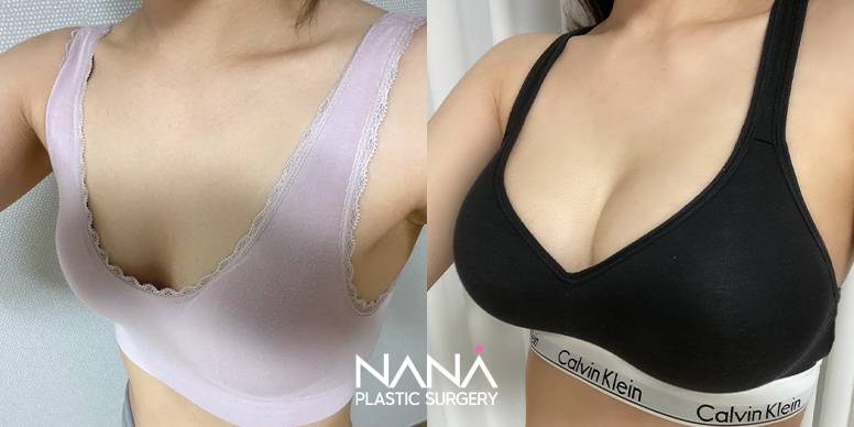 Breast Before & After — Before & After