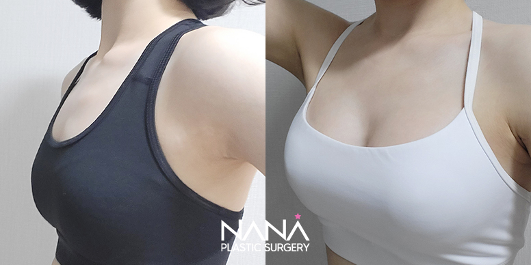 Breast Before & After — Before & After