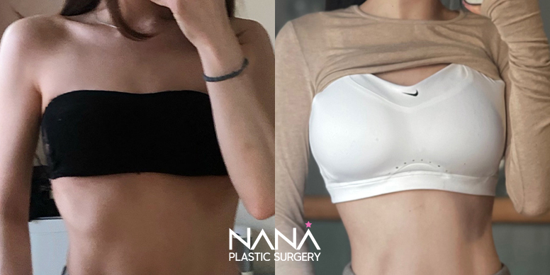Breast Before & After — Before & After