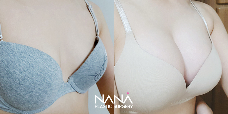 Breast Before & After — Before & After