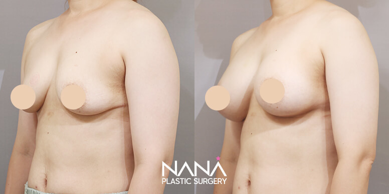 Breast Before & After — Before & After