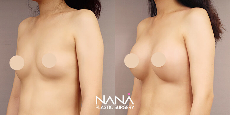 Breast Before & After — Before & After