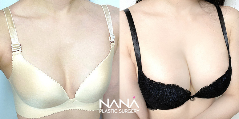 Breast Before & After — Before & After