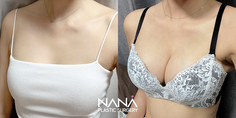 Breast Before & After — Before & After