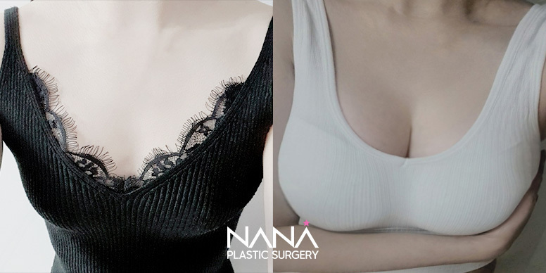 Breast Before & After — Before & After