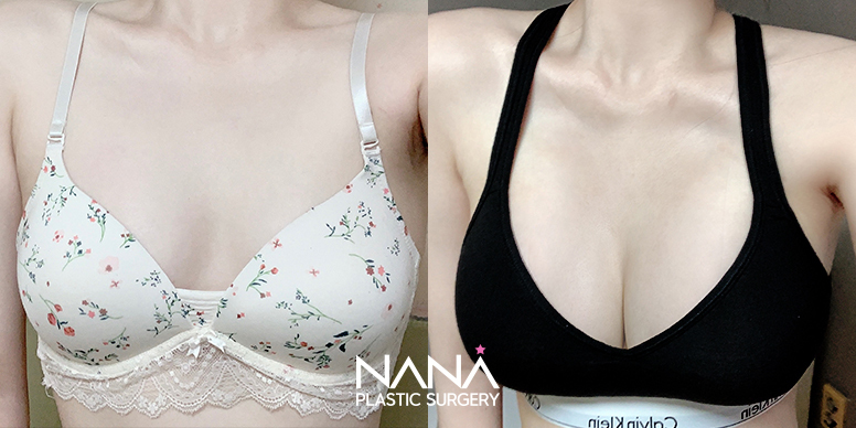Breast Before & After — Before & After