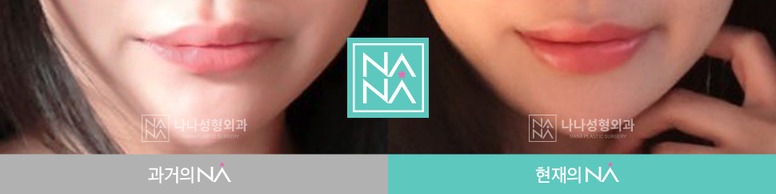 Other Before & After — Before & After