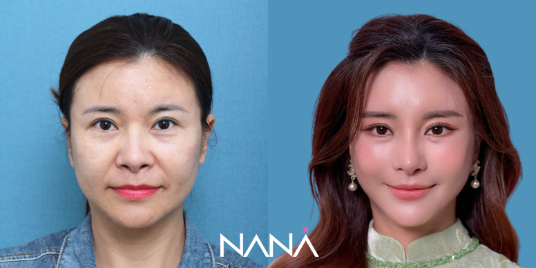 リフティング 症例写真 — 症例写真