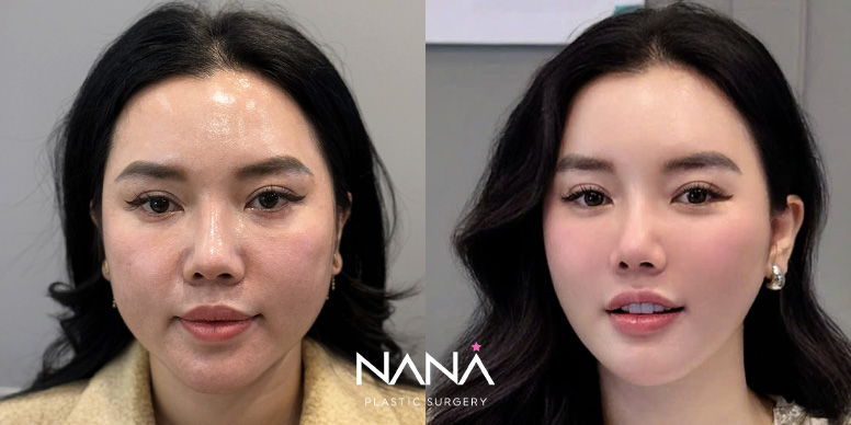 Facial Contouring Before & After — Before & After