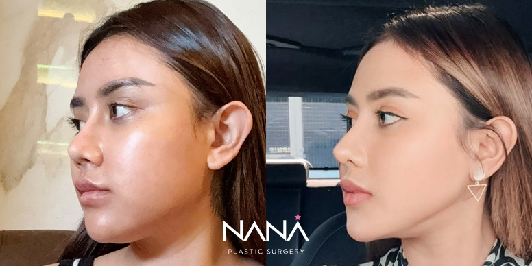 Before & After Before & After
