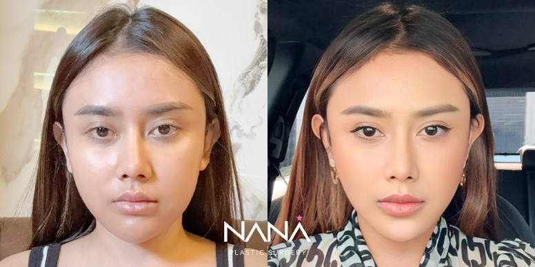 Facial Contouring Before & After — Before & After