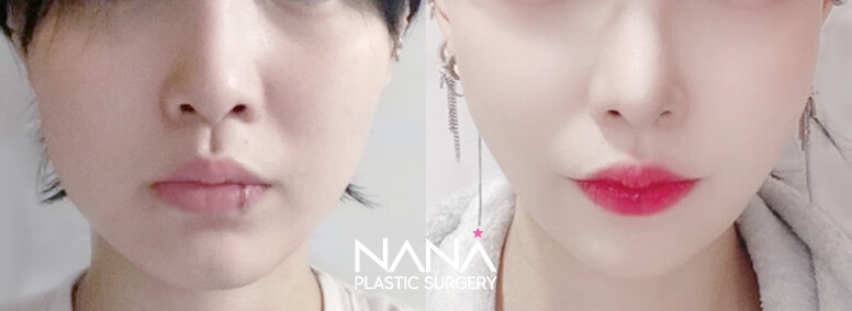 Facial Contouring Before & After — Before & After