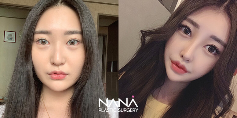 Facial Contouring Before & After — Before & After