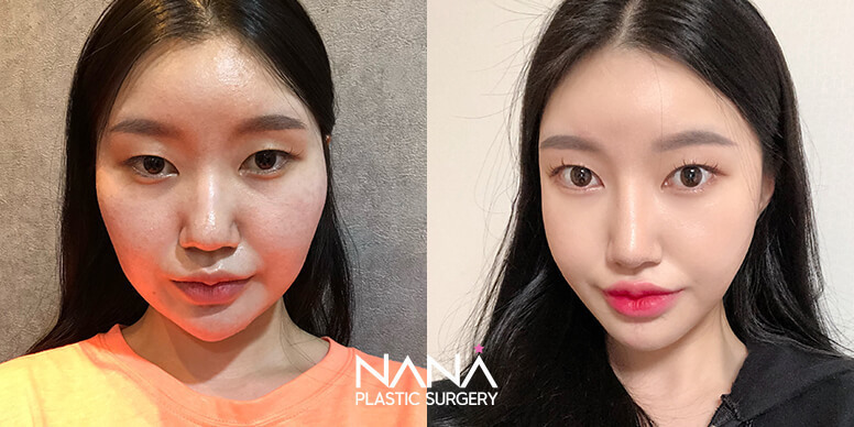 Facial Contouring Before & After — Before & After