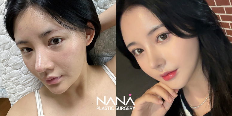 Facial Contouring Before & After — Before & After