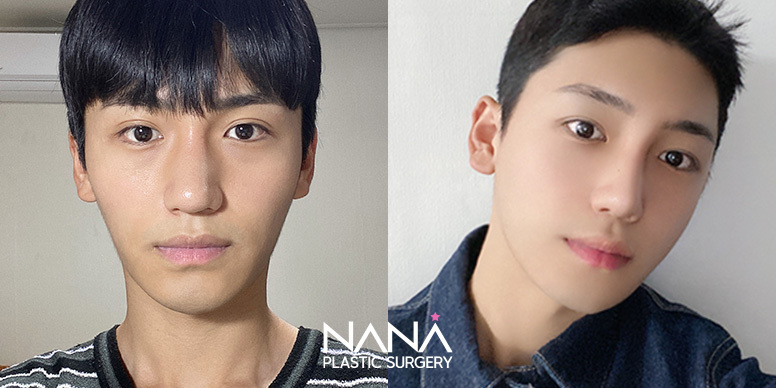Facial Contouring Before & After — Before & After