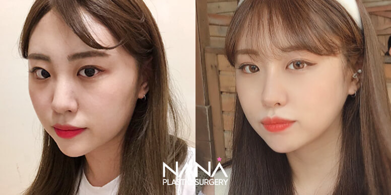 Before & After Before & After