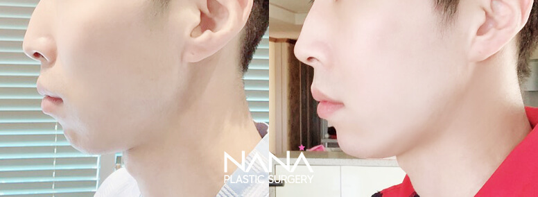 Before & After Before & After
