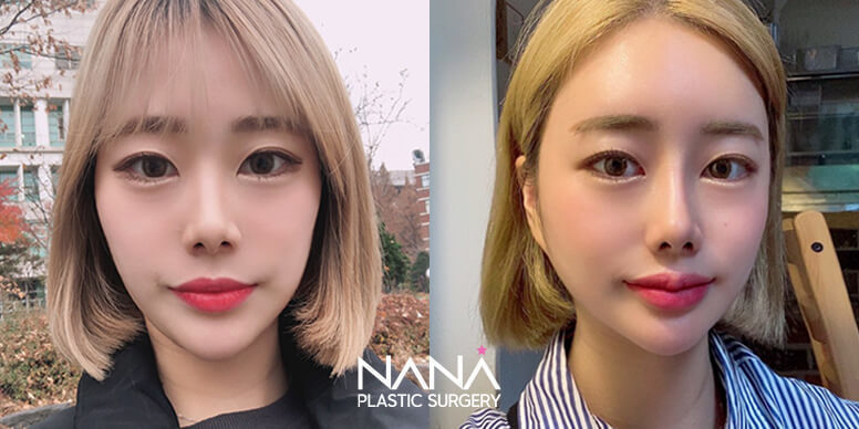 Facial Contouring Before & After — Before & After