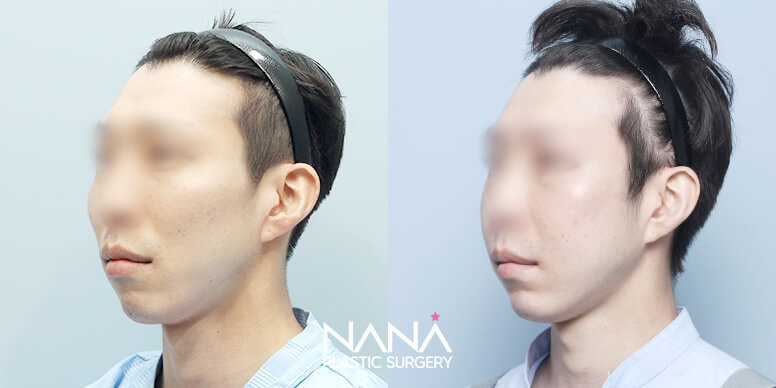 Facial Contouring Before & After — Before & After