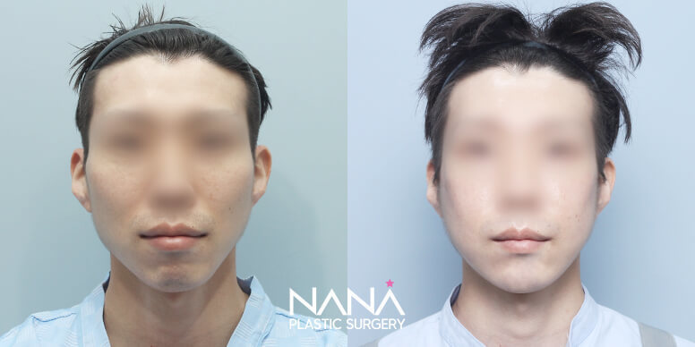Before & After Before & After