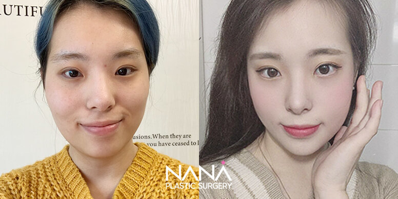 Facial Contouring Before & After — Before & After