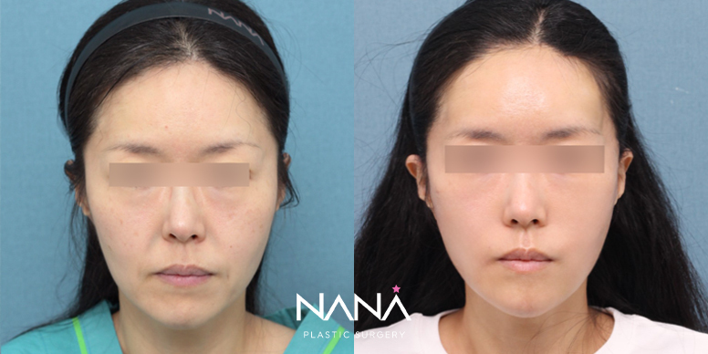リフティング 症例写真 — 症例写真